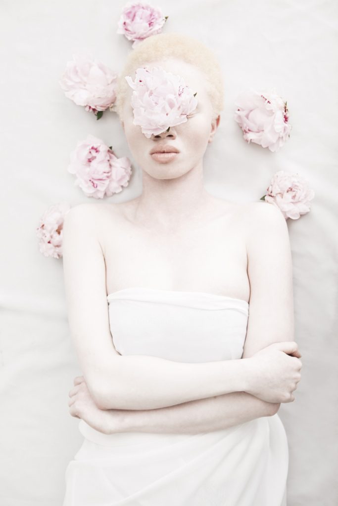 albinos (2)
