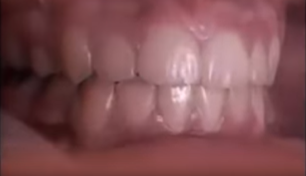 Как брекеты выпрямляют зубы